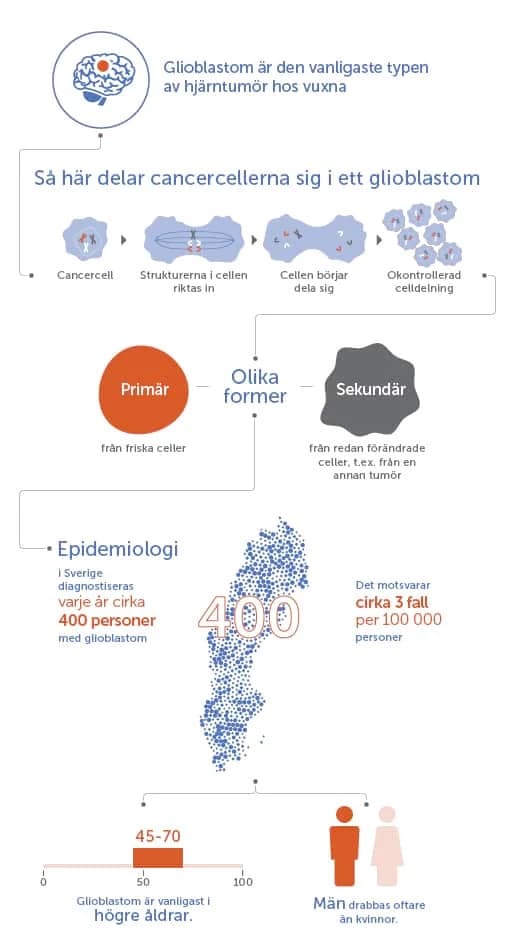 Illustration of glioblastoma brain tumor showing tumor location and affected brain areas